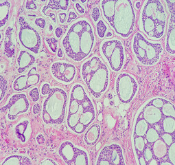 Adenoid cystic carcinoma