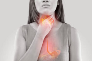 Woman suffering from Achalasia