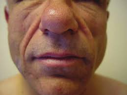 lipodystrophy