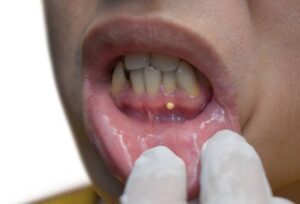 An Abscessed tooth is characterized by a pocket of pus around an infected tooth's root and can affect anyone, irrespective of age