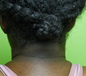 Acanthosis nigricans (AN) may lead to skin pigmentation