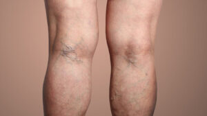 VARICOSE VEINS