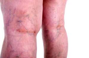 VARICOSE VEINS AND SPIDER VEINS