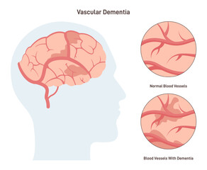 VASCULAR DEMENTIA