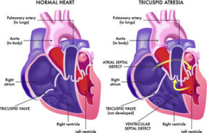 VENTRICULAR SEPTAL DEFECT (VSD)