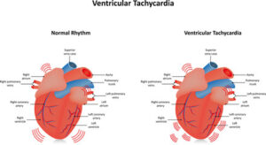 Ventricular tachycardia