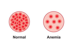 VITAMIN B12 DEFICIENCY ANEMIA