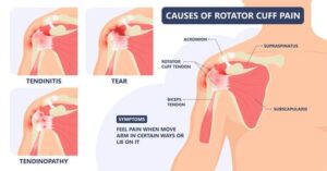 Rotator Cuff Injuries