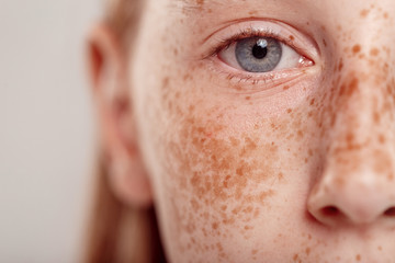 moles, freckles, and skin tags