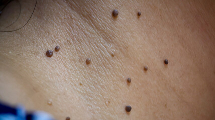 Skin Tag